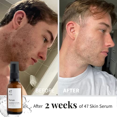 47 Skin Hydrating Face Serum for Acne Scars and Dark Spots 6 47 Skin Hydrating Face Serum for Acne Scars and Dark Spots - Image 6